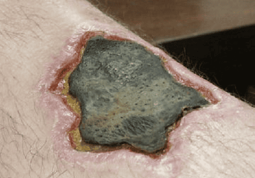 Krokodil Drug Facts