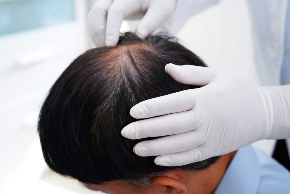 Medical staff looking at a man’s balding scalp before hair drug test 